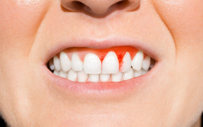 Diş Eti İltihabı İle İlgili Her Şey