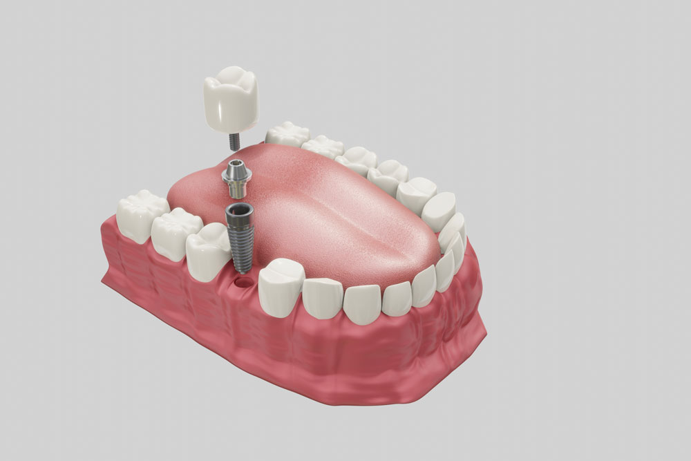 10 Things You Should Know About Dental Implants