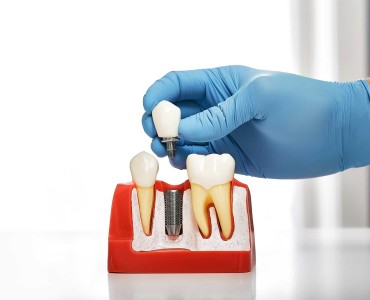 Differences Between Dental Implants and Other Restorative Options