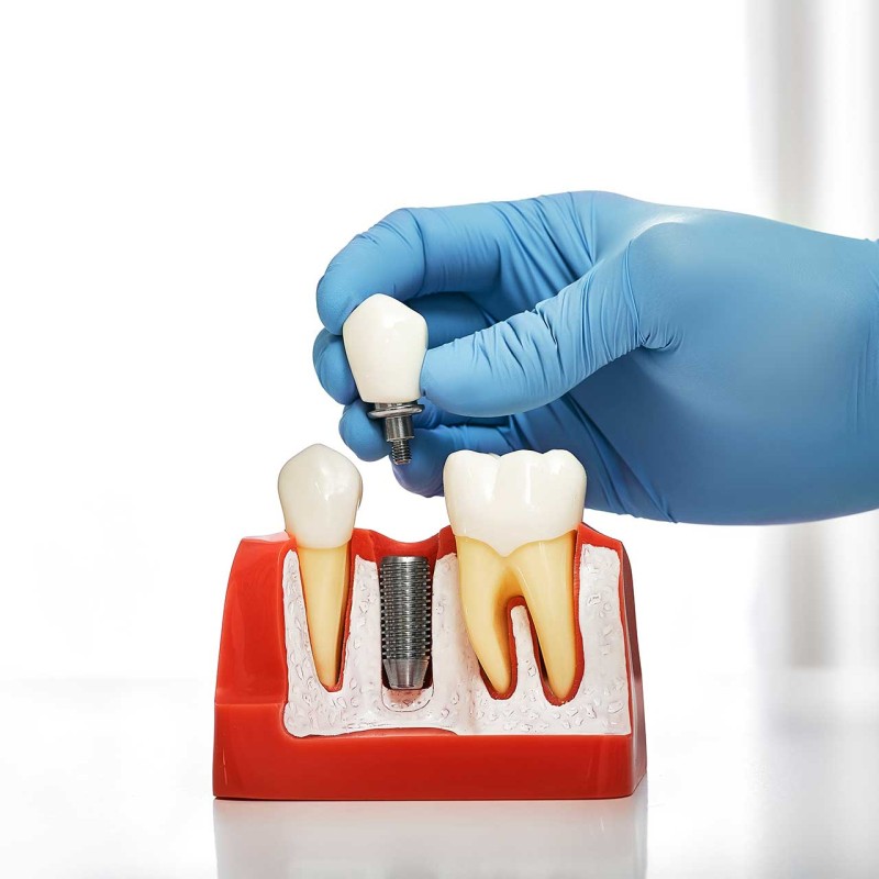 Differences Between Dental Implants and Other Restorative Options