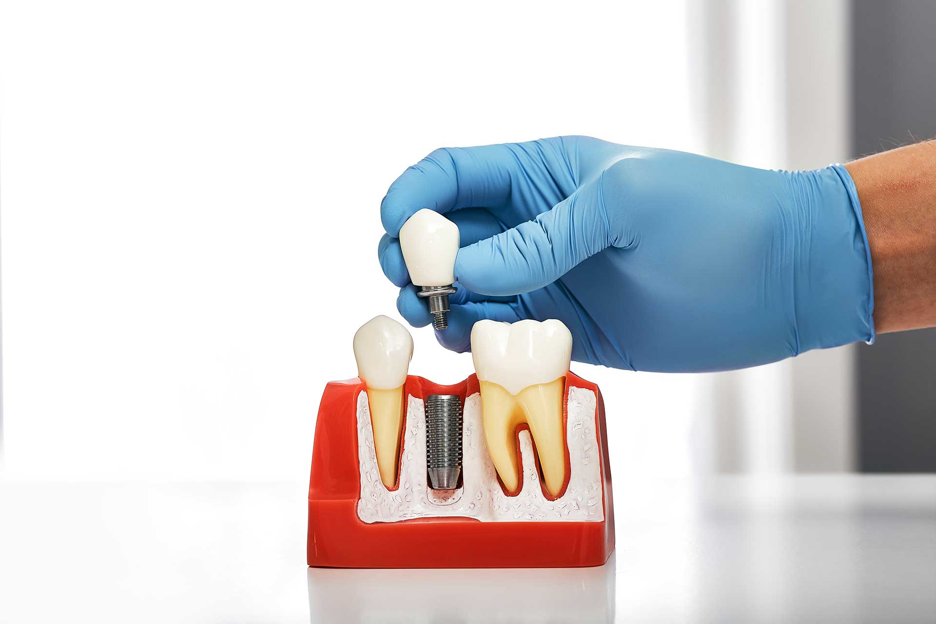 Differences Between Dental Implants and Other Restorative Options