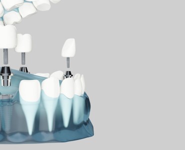 Things You Need to Know About Dental Implants