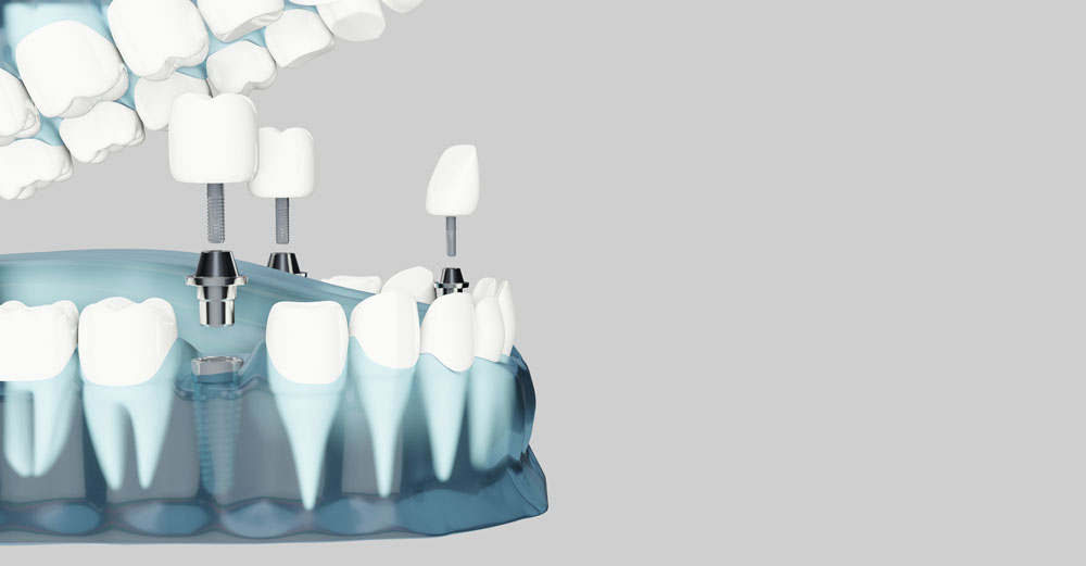 Things You Need to Know About Dental Implants