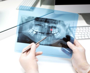 Symptoms of A Tooth Cyst and the Importance of Early Diagnosis