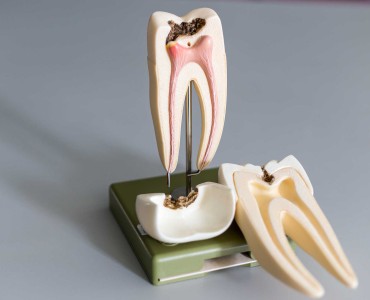 Things You Need to Know About Tooth Root Decay