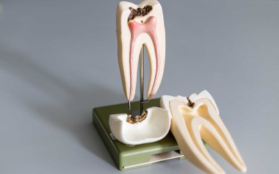 Things You Need to Know About Tooth Root Decay