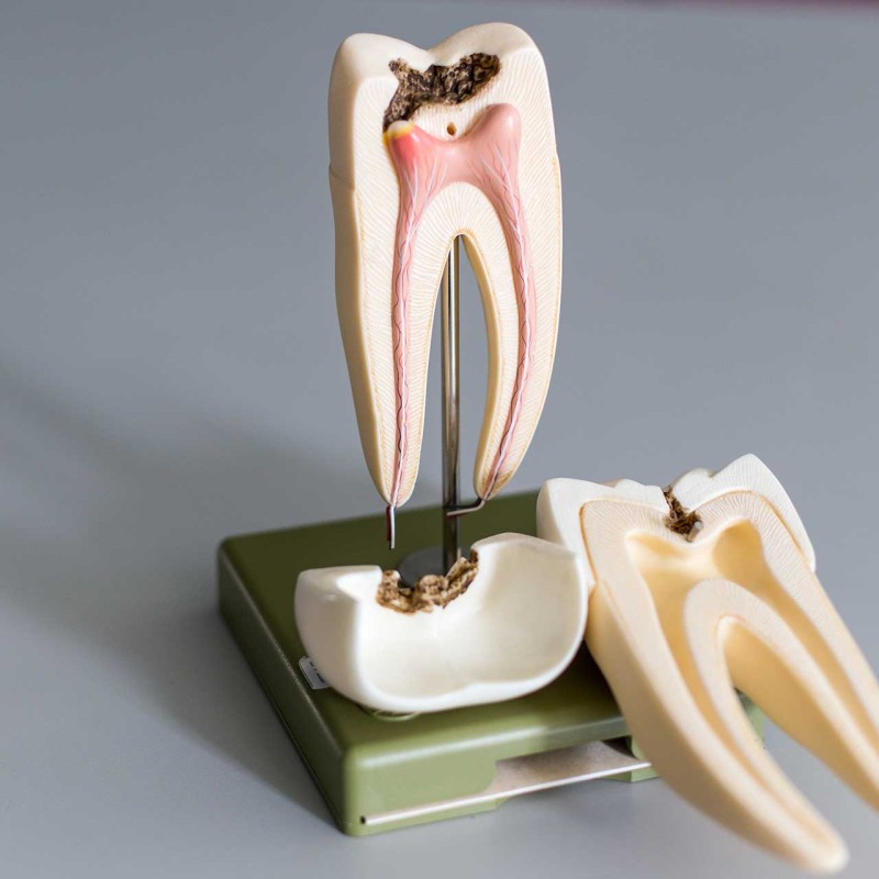 Things You Need to Know About Tooth Root Decay