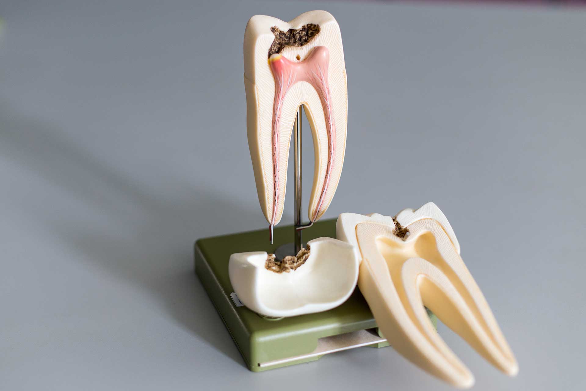 Things You Need to Know About Tooth Root Decay