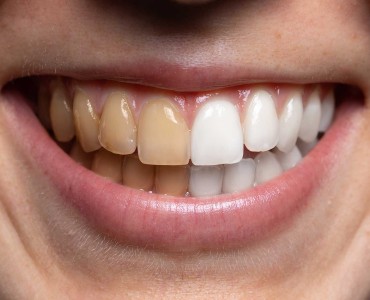 Preserving Your Bright Smile: Preventing and Treating Tooth Stains