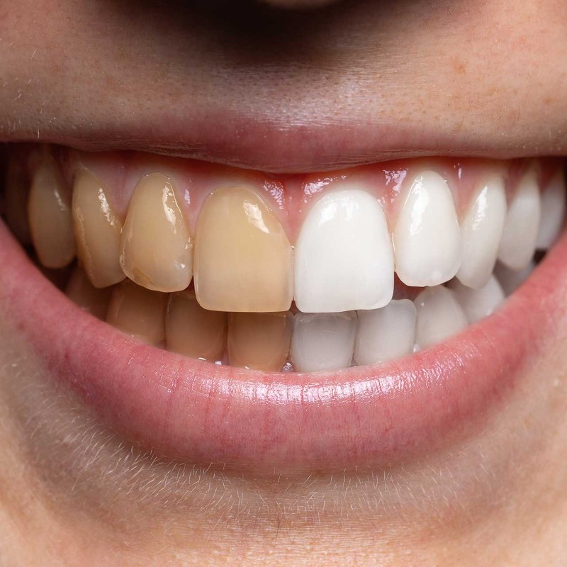 Diş Lekelerini Önlemek ve Tedavi Etmek için Neler Yapabilirsiniz?