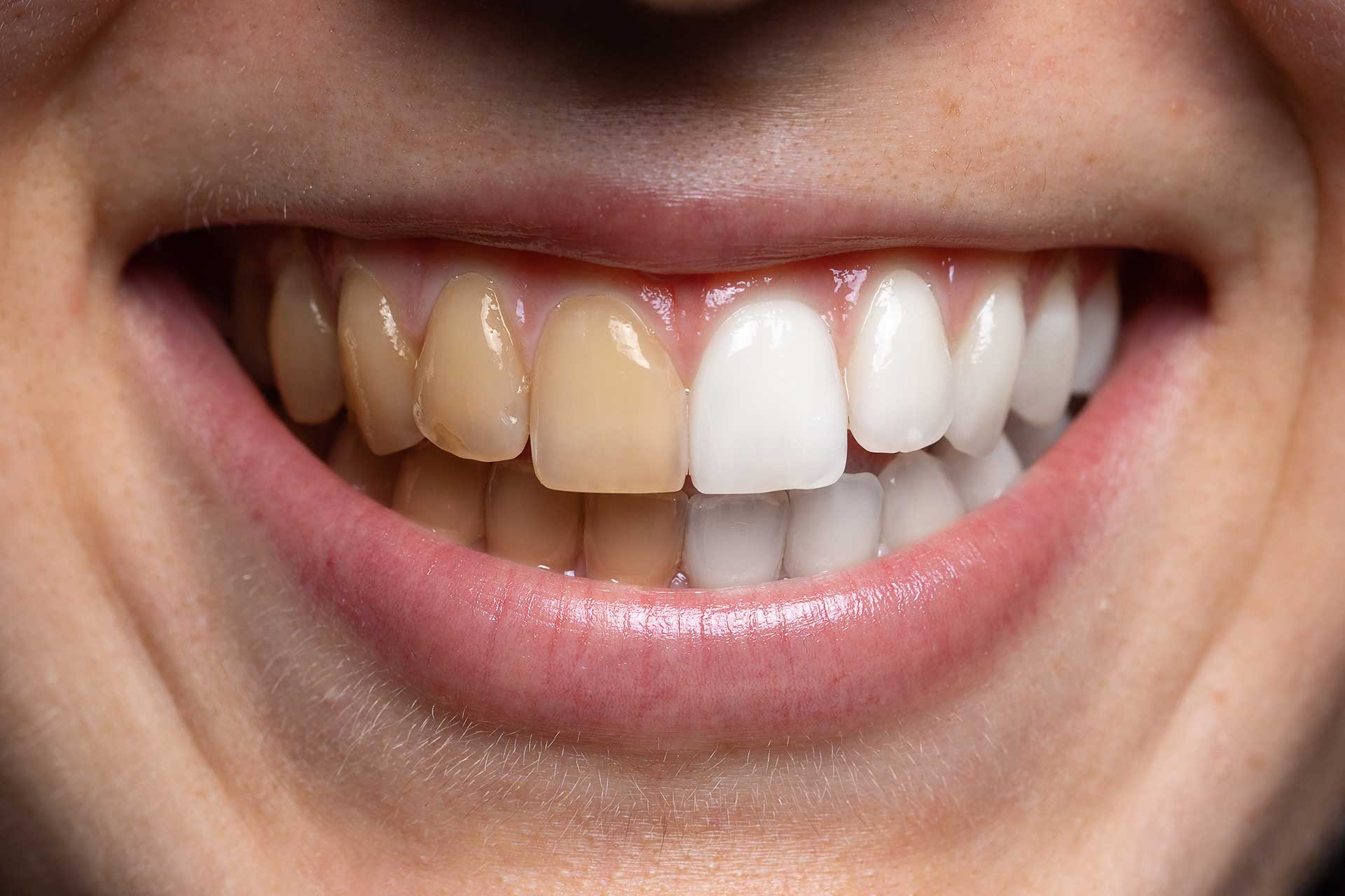 Preserving Your Bright Smile: Preventing and Treating Tooth Stains