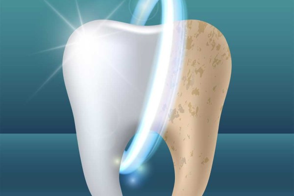 Diş Lekesi Oluşmasının Nedenleri Ve Çözümleri