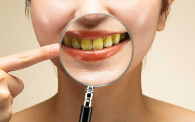 Dişlerdeki Sararmayı Engellemek İçin Bilinmesi Gerekenler