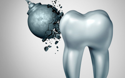 Diş Minesi Aşınması ve Tedavisi