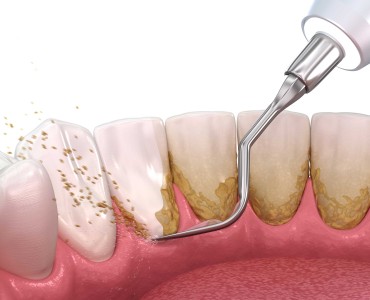 What is Dental Tartar? How to Clean it?