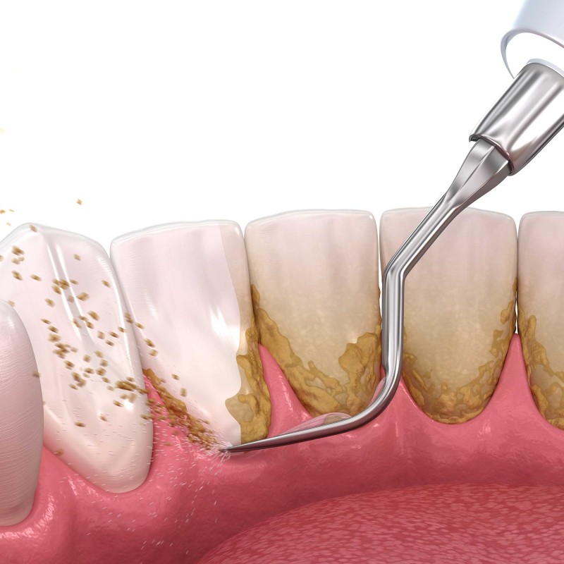 What is Dental Tartar? How to Clean it?