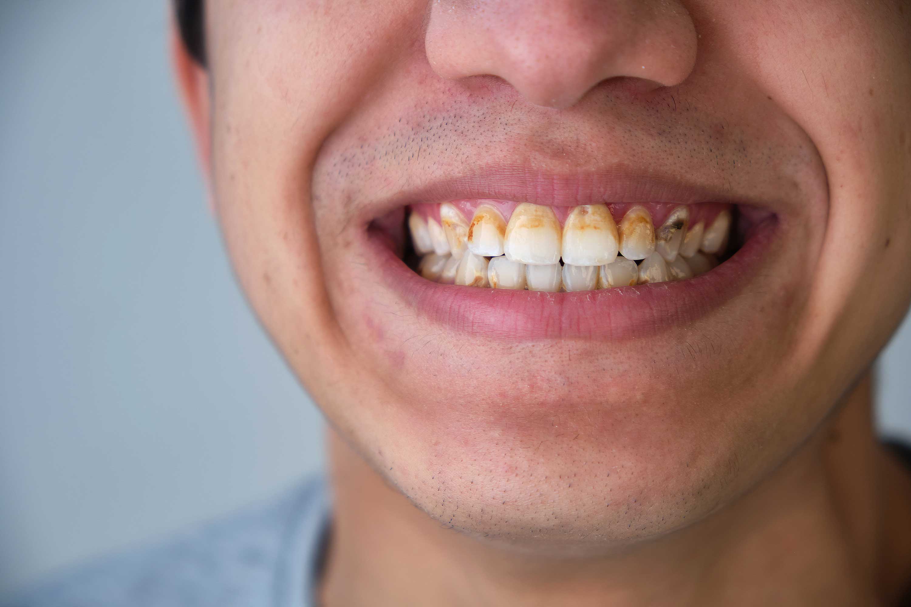 What is Dental Tartar? How to Clean it? | Dentevim Dental Clinic What is Dental Tartar? How to Clean it? | Dentevim Dental Clinic