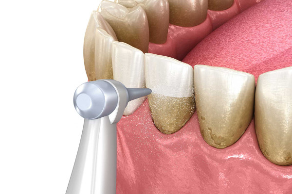 Diş Taşı Temizliğinin Önemi