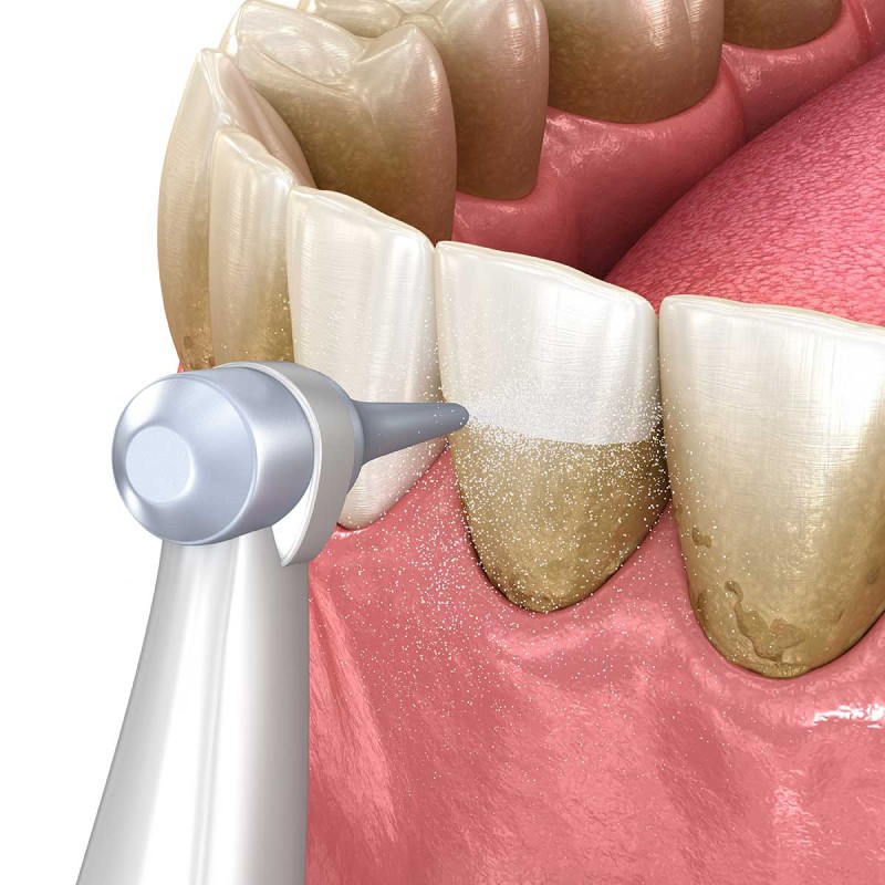 The Importance of Dental Cleaning