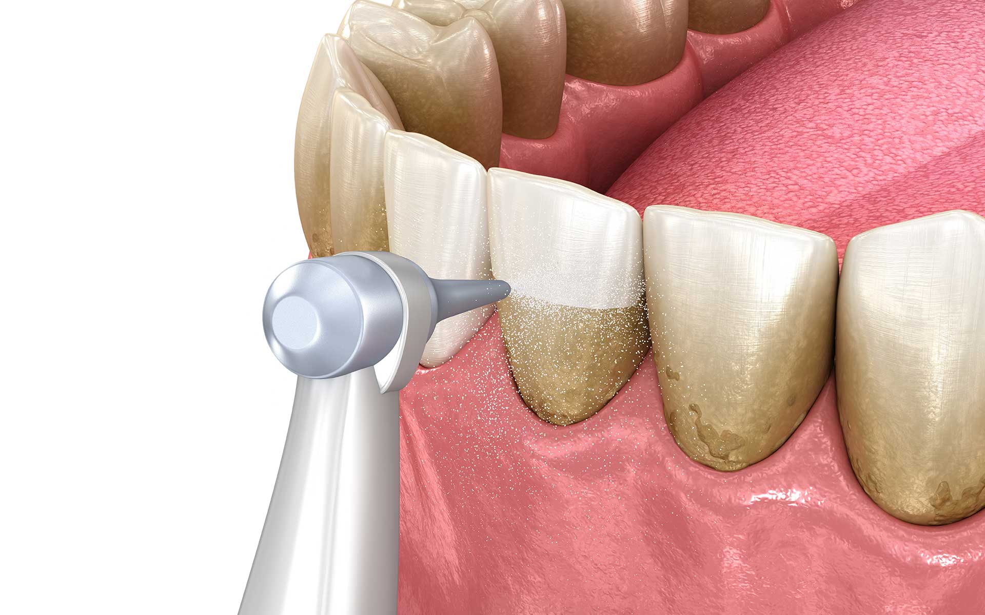 The Importance of Dental Cleaning