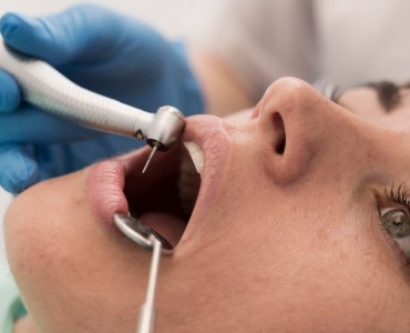 How to Care for Your Teeth After Tartar Removal
