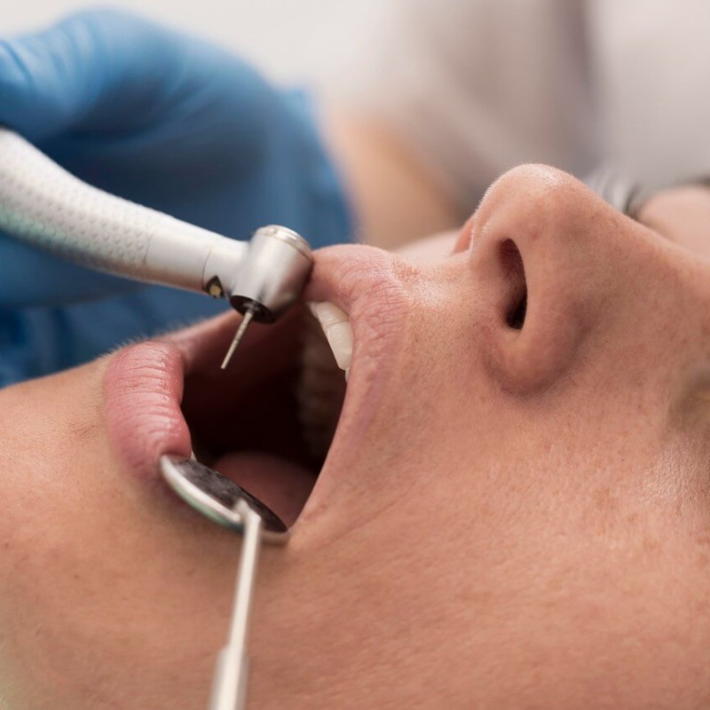 How to Care for Your Teeth After Tartar Removal