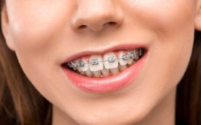 Diş Teli Takmadan Dişler Düzelir Mi?