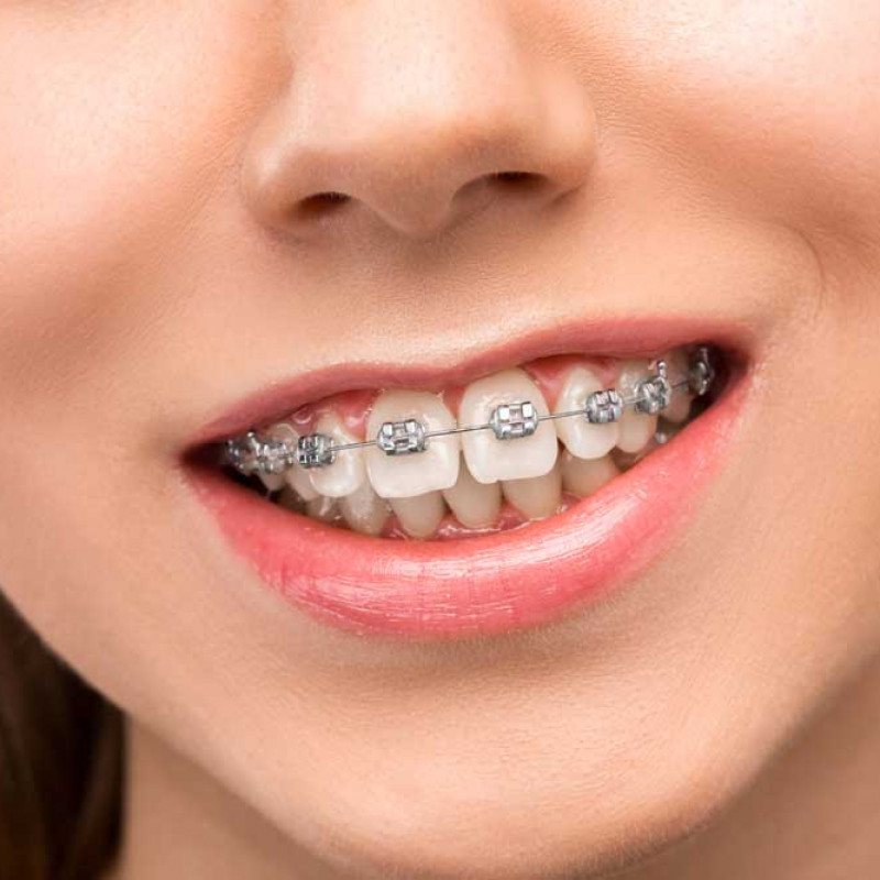 Can The Teeth Be Fixed Without Braces? 