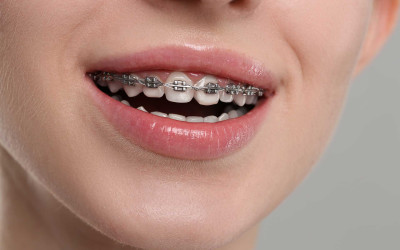 Diş Teli Kullanımı Hangi Yaşta Ne Kadar Etkili?