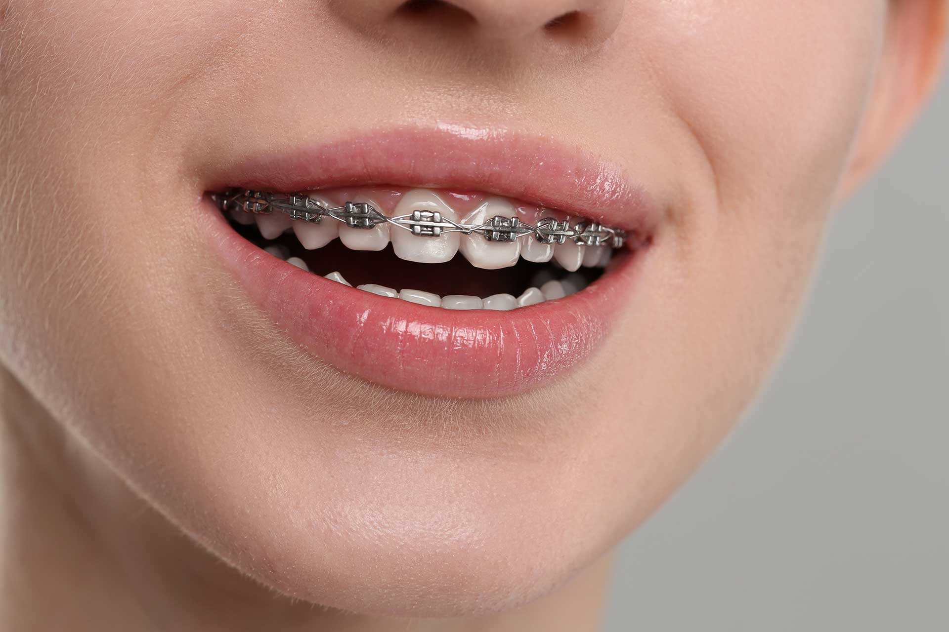 How Effective Is Braces Treatment at Different Ages?