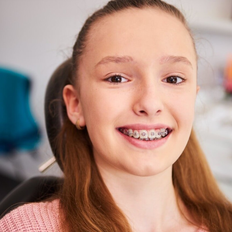 Things to Consider When Using Braces