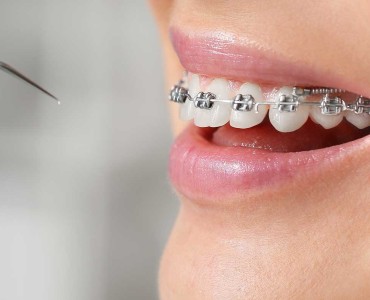 How to Care After Braces Treatment