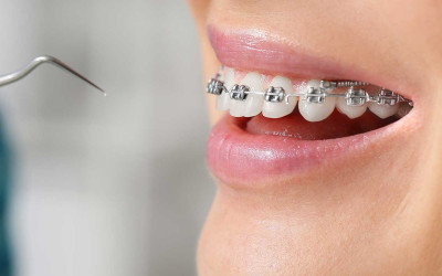 Diş Teli Tedavisi Sonrası Bakım: Nelere Dikkat Etmelisiniz?