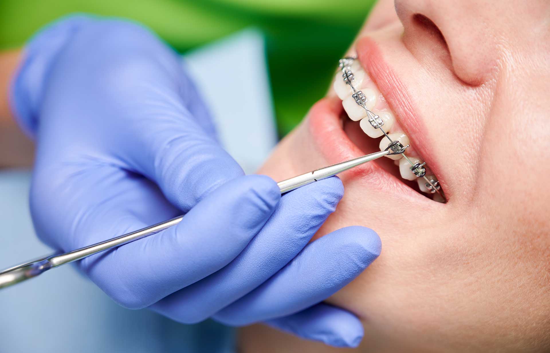 Braces Treatment : Orthodontic Solutions for Adults