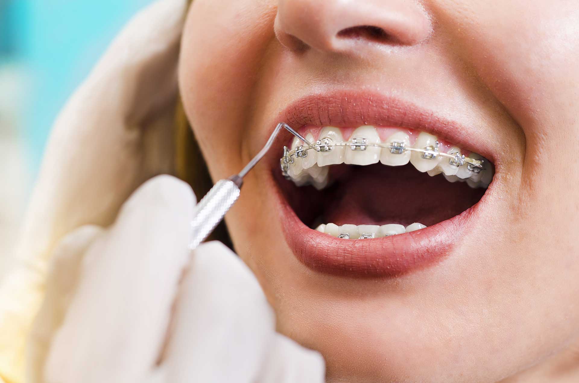 Factors That Can Damage Braces