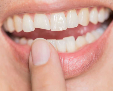 Diş Travması Nedir? Türleri Nelerdir?