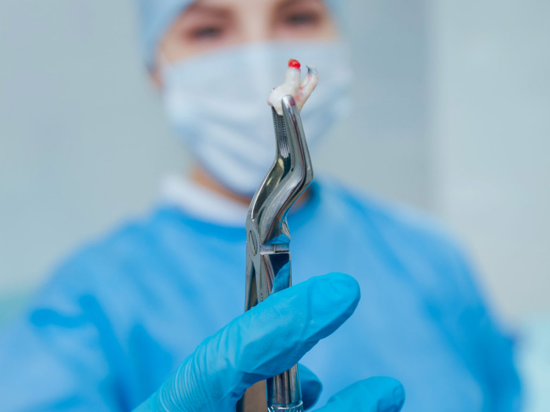 Tooth Extraction and Impacted Tooth Extraction