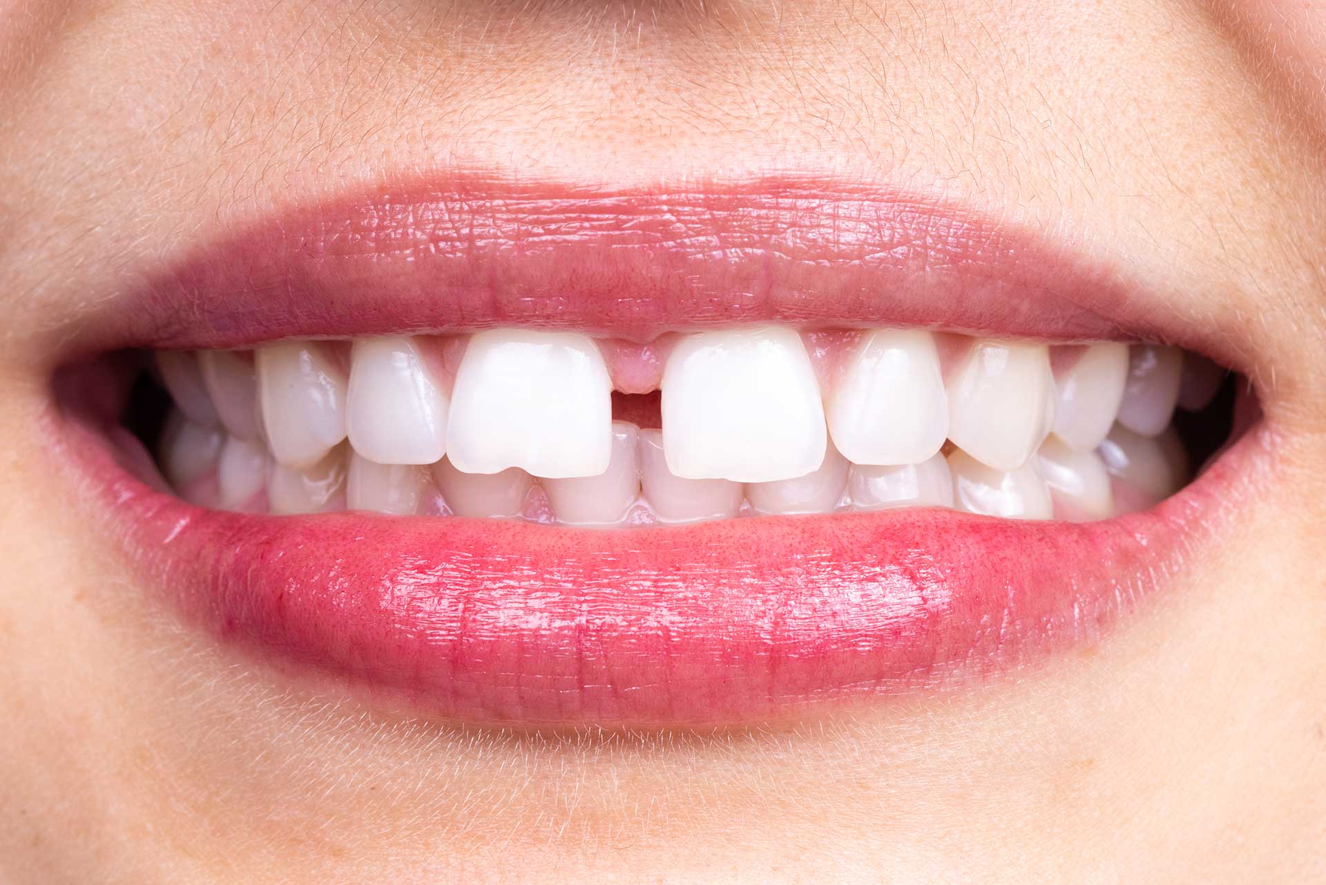 Can Gaps Between Teeth (Diastemata) Be Treated?