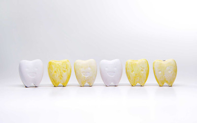 Dişlerde Neden Renk Değişikliği Meydana Gelir?