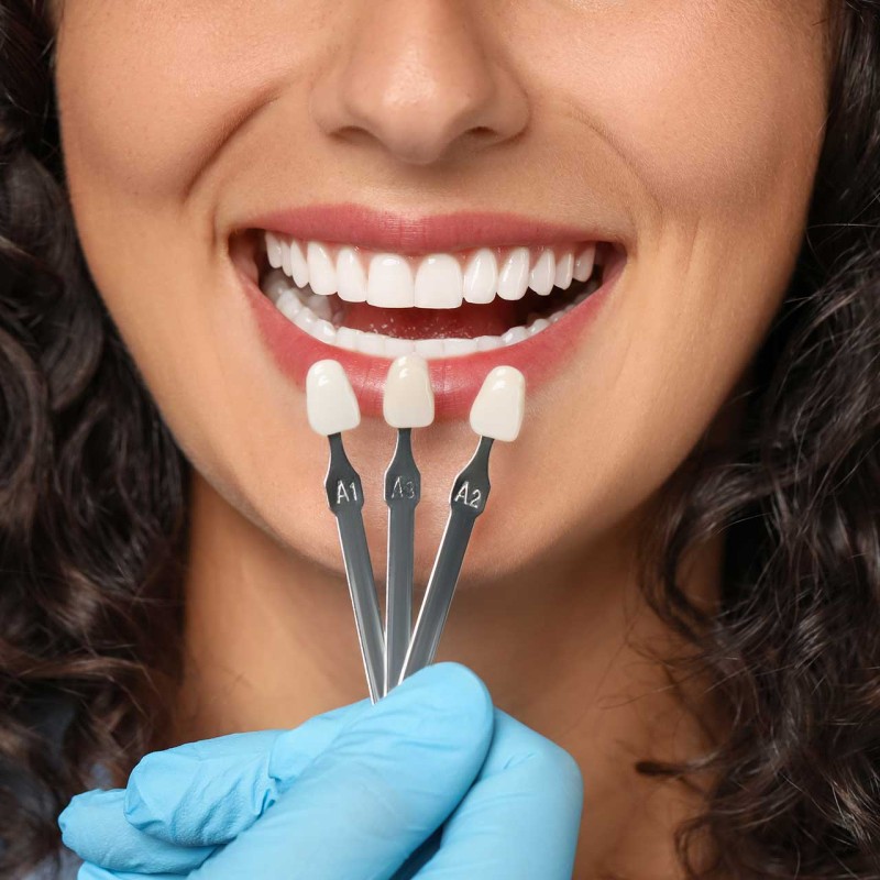 Aesthetic Dental Veneers: Benefits and Types
