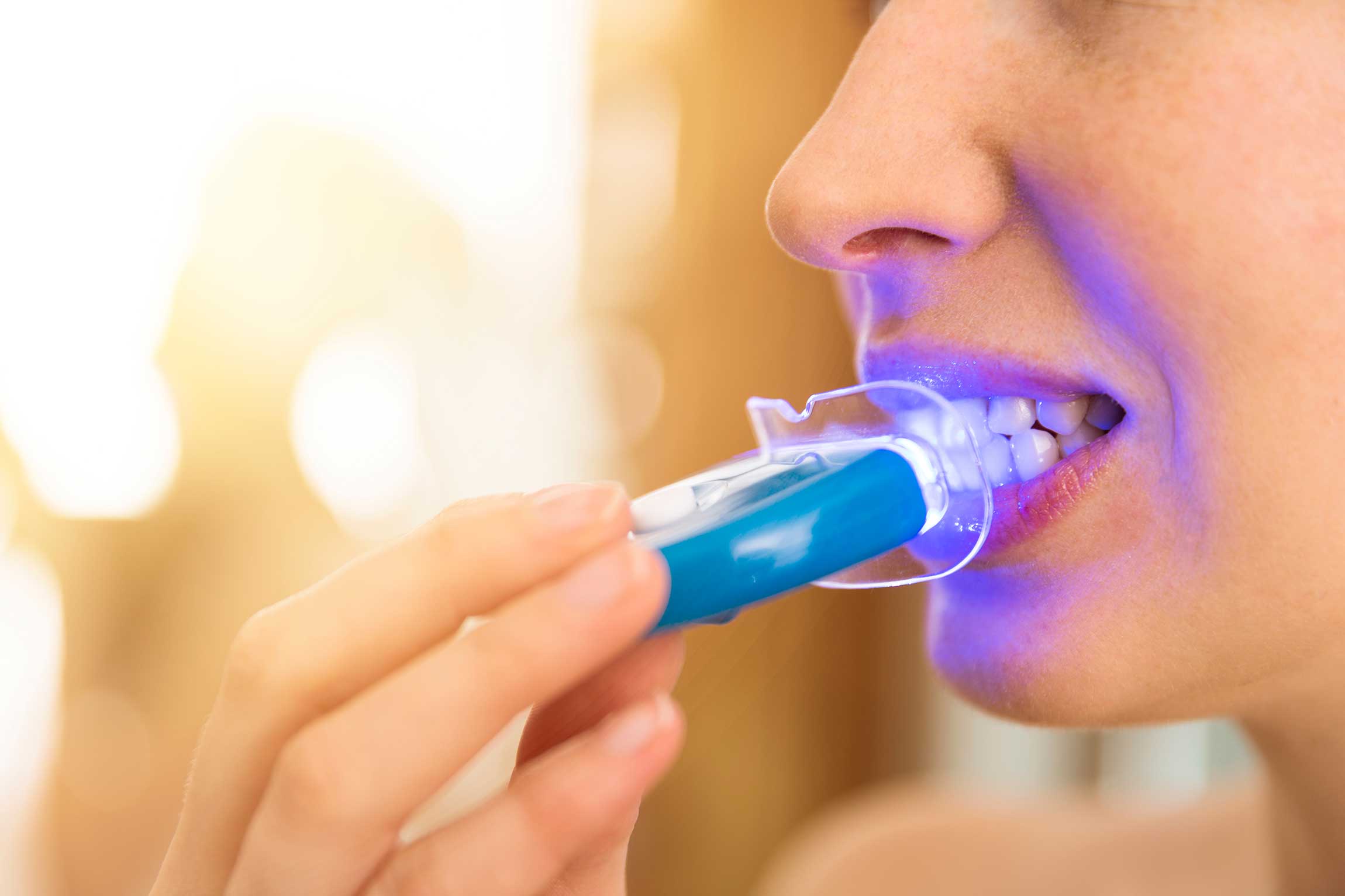 Home Teeth Whitening (Home Bleaching) | Dentevim Dental Clinic