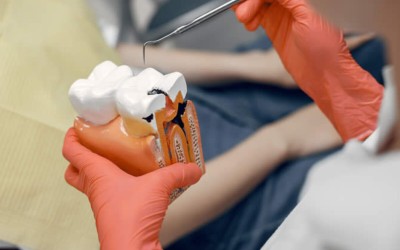 Fiber Post Uygulaması