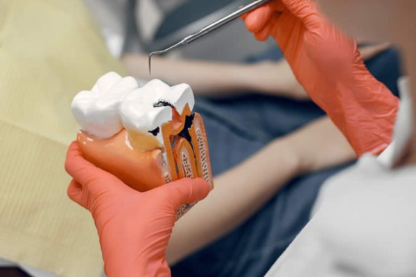 Fiber Post Uygulaması