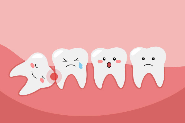 Gömülü Diş Çekimi Hakkında Bilmeniz Gerekenler