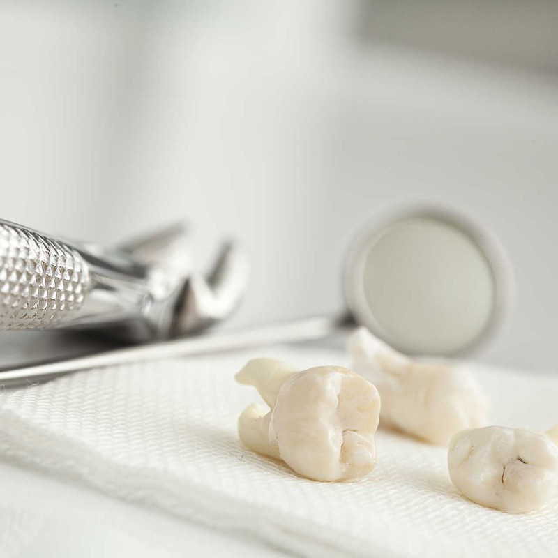 Reshaping After Tooth Loss with Dental Bone Grafting