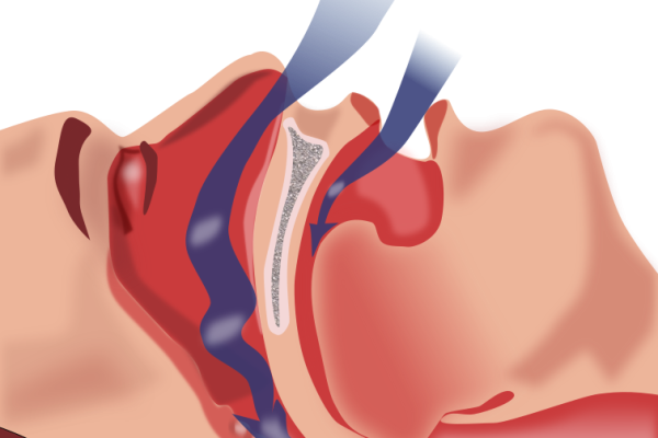 Horlama Ve Uyku Apnesi Tedavisi