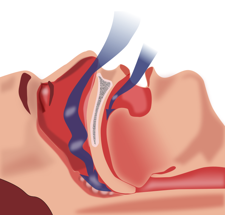 Treatment Of Snoring And Sleep Apnea | Dentevim Dental Clinic