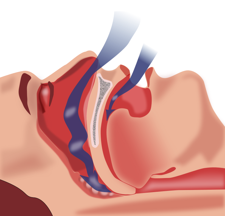 Treatment Of Snoring And Sleep Apnea