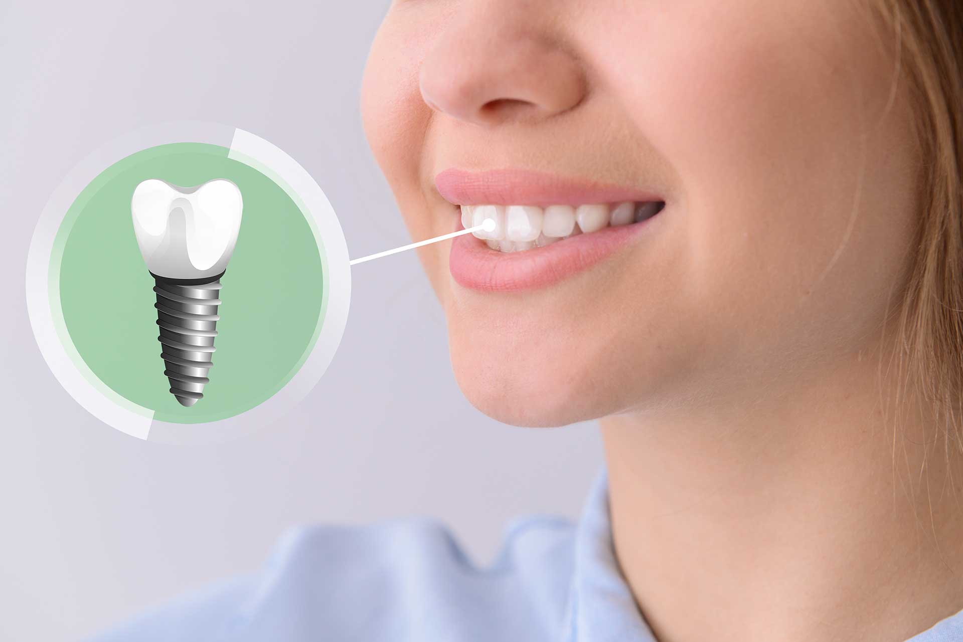 Implant Teeth: Regain Your Missing Teeth with Confidence