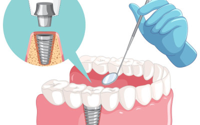 Factors Influencing the Success of Dental Implant Treatment